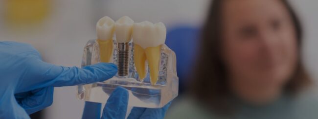 implantes cuidar implantes cuidar