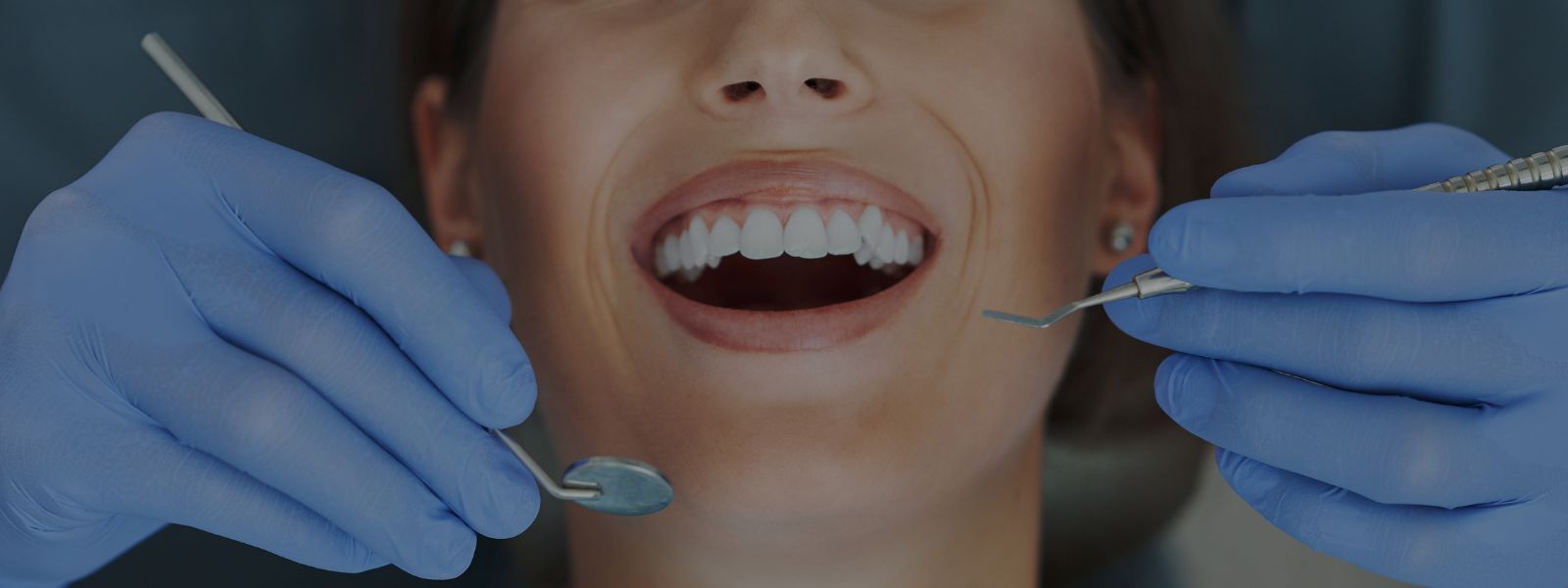 Erosión del esmalte dental