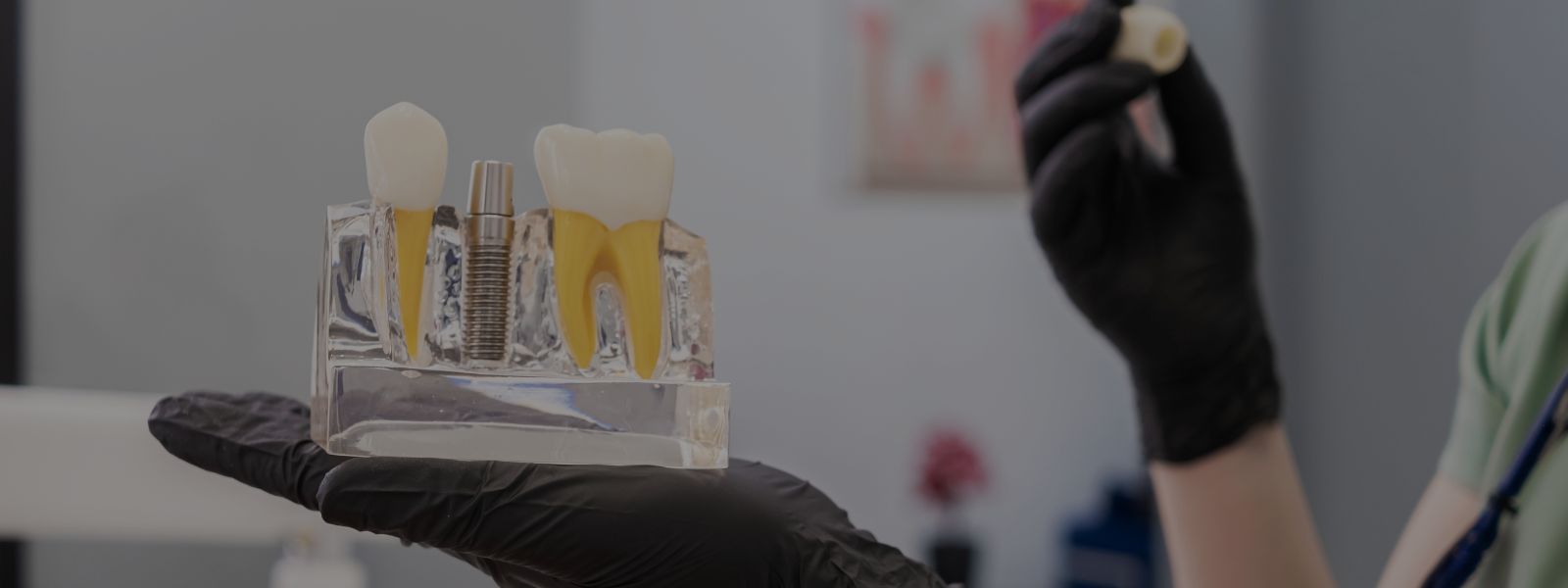 Mantenimiento de implantes dentales: cómo cuidar tu sonrisa