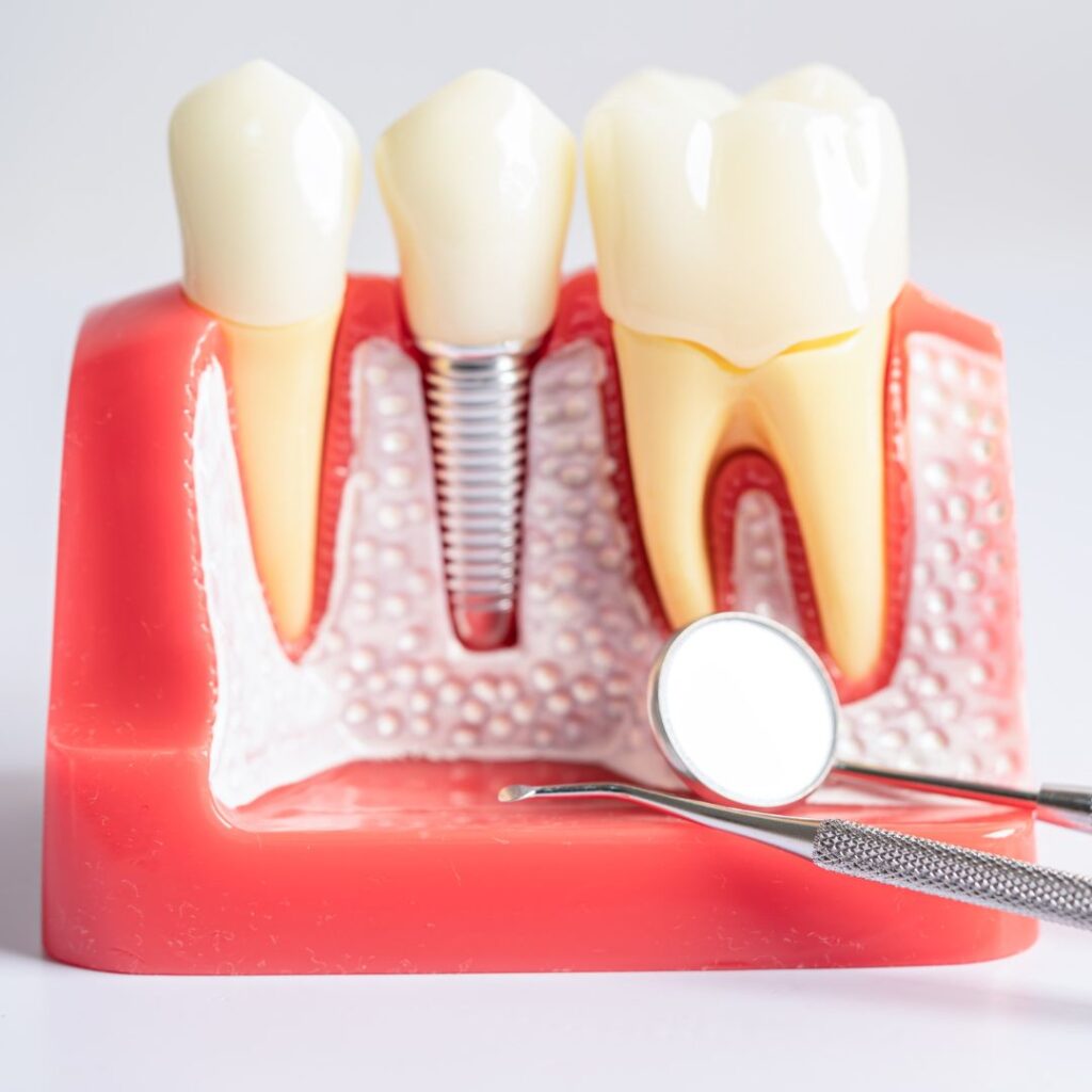 Mantenimiento de implantes dentales: cómo cuidar tu sonrisa