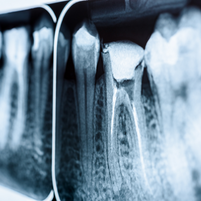 diente con endodoncia