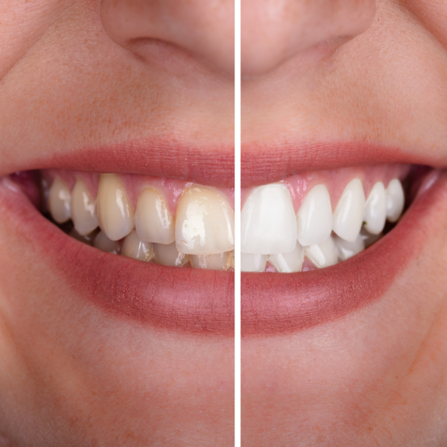 blanqueamiento dental