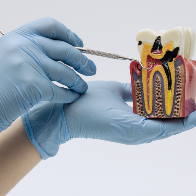 caries dental